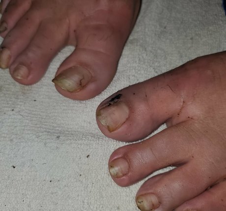Missfeetstink